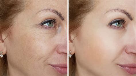 What Are The Benefits Of Microneedling