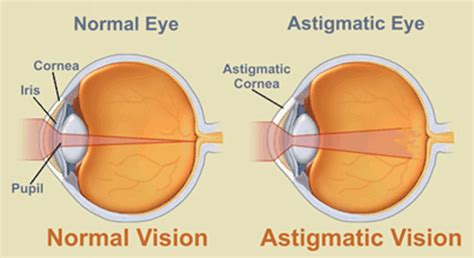 All About Astigmatism Zenni Optical
