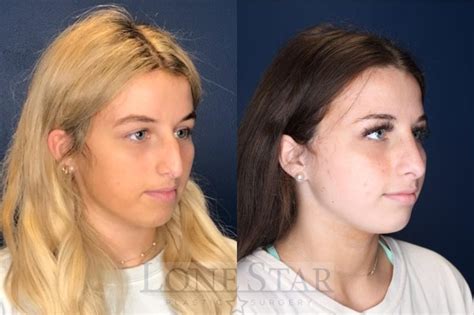 Rhinoplasty Before And After Pictures Case 134 Frisco Tx Lone Star
