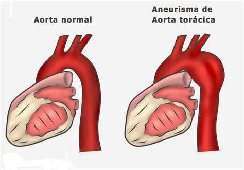 Aneurisma Da Aorta Torácica Dr Fábio Rossi