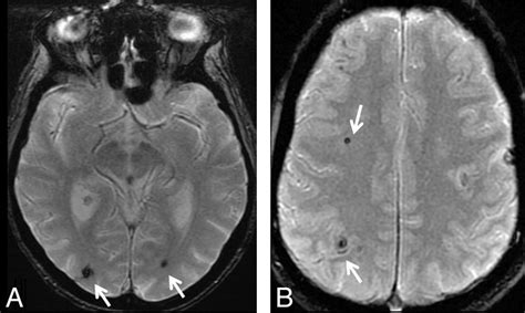 Brain Mri Findings In Neurologically Asymptomatic Patients With