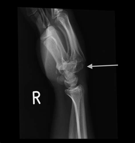 Dorsal Dislocation Of The Trapezoid With Carpo Metacarpal Dislocations