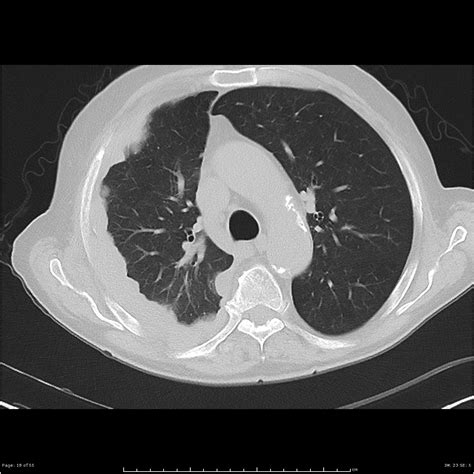 Mesothelioma can occur either in the lung or in the abdominal cavity. Mesothelioma: pleural | Image | Radiopaedia.org