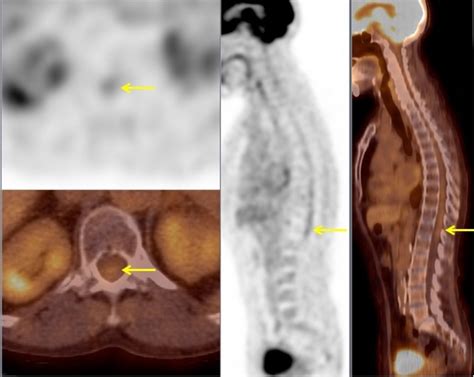 Patterns And Prevalence Of F18 Fdg Uptake On Petct In Conus Medullaris