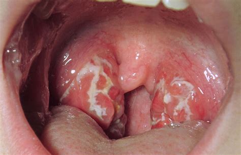 White Spots On Tonsils All You Need To Know
