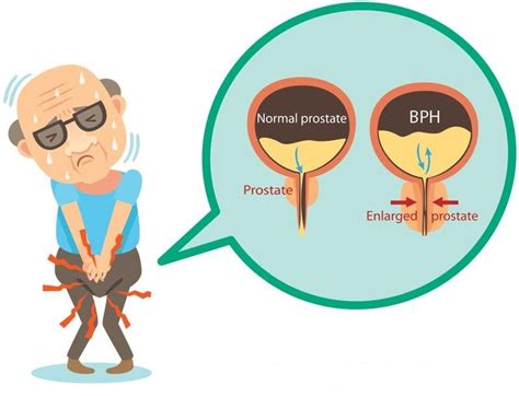 Benign Prostatic Hyperplasia Enlarged Prostate