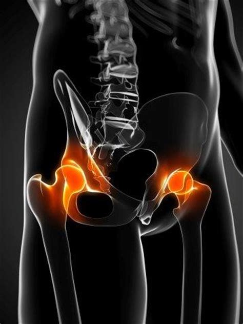 Opposite of the rest of the group. Sore groin? Could it be Femoroacetabular Impingement? - La ...