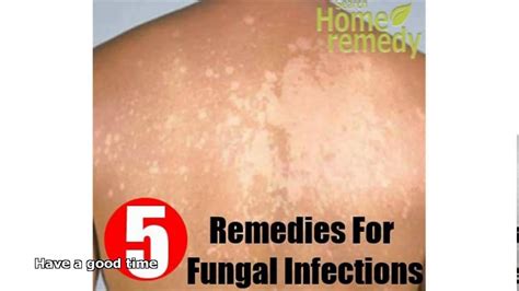 Fungal Skin Infection Treatment Youtube