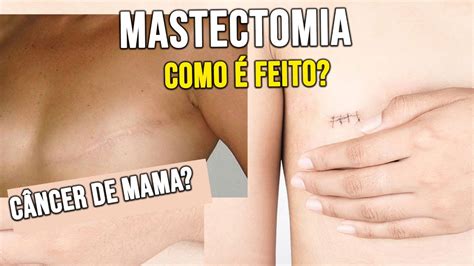 Mastectomia Como É Feita CÂncer De Mama Youtube