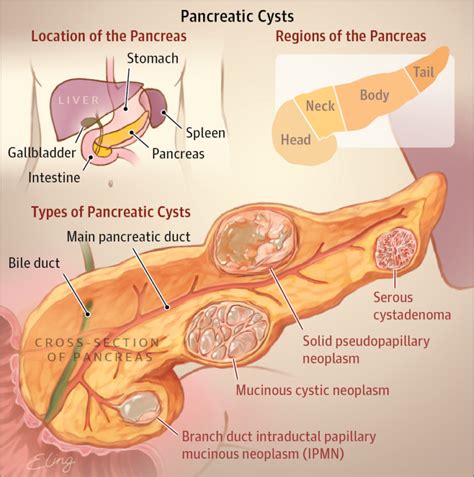 What Is Pancreatic Cyst Health Life Media