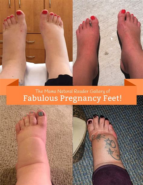 Swollen Feet During Pregnancy Edema Natural Remedies Swollen Feet