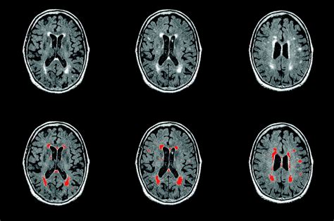 Anatomical Mapping Of White Matter Hyperintensities Wmh Stroke