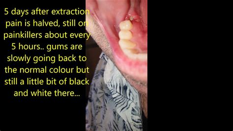 Molar Extraction Healing Process Youtube