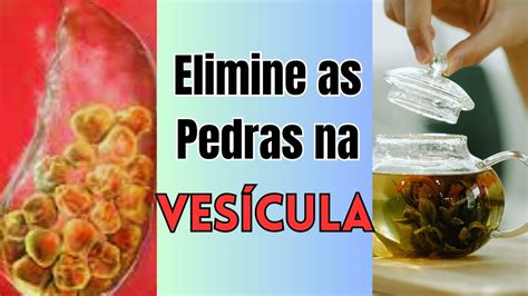 Bicarbonato Para Pedra Na Vesícula