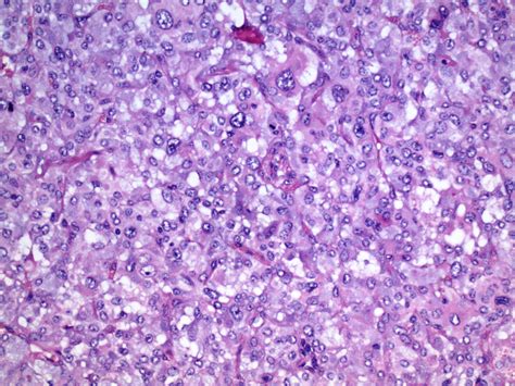 Pheochromocytoma Pathology Image