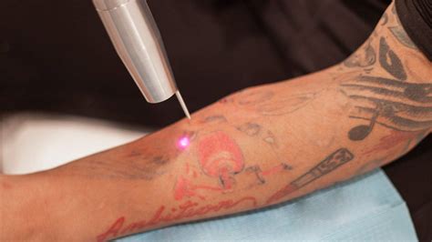 Everything You Need To Know About How Tattoos Are Removed Study Iq