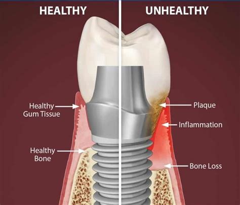 Dental Implant Failure Reasons And Prevention Dantkriti Dental Clinic