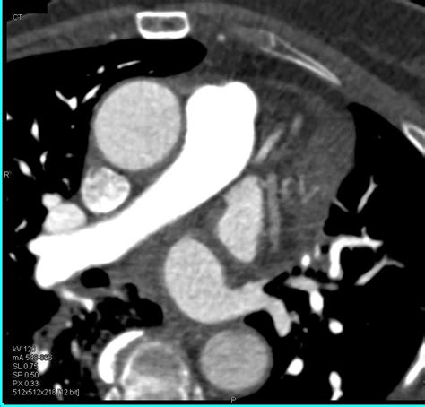 Enlarged Left Ventricle Cardiac Case Studies Ctisus Ct Scanning
