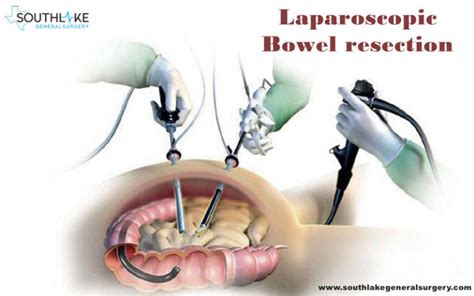 Bowel Resection Why Is Required Recovery Post Surgery Southlake General Surgery