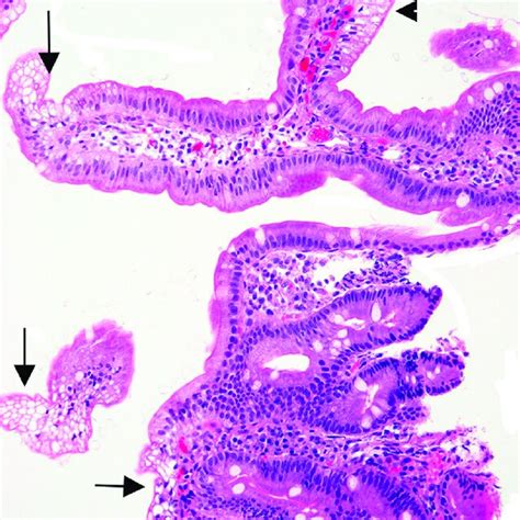 Duodenal Mucosa With Intact Villous Architecture And Increased
