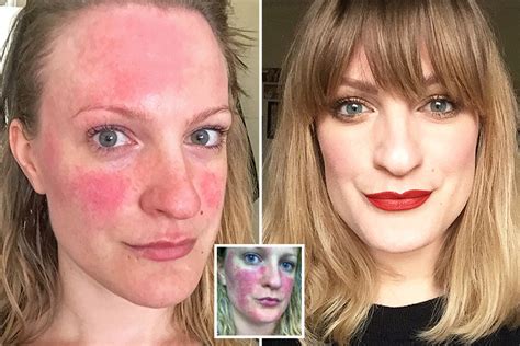 Who Is Lex Gillies Beauty Blogger Who Ditched Gluten And Dairy To Combat Rosacea Flare Ups