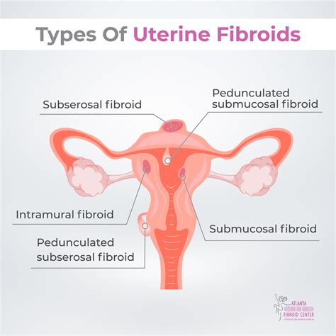 Large Fibroids And Pregnancy All You Need To Know
