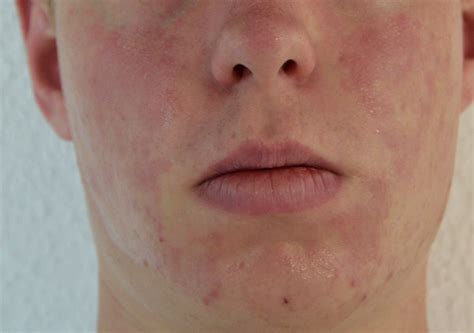 Histaminintoleranz Hautausschlag Bilder
