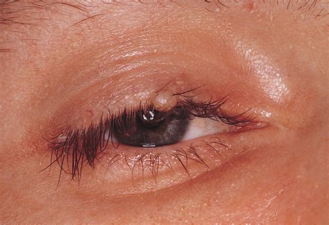 Eyelid Nodule A Sentinel Lesion Of Disseminated Cryptococcosis In A