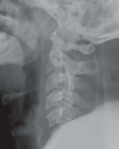 Obscured Cervicothoracic Junction With Anterolisthesis Radiology Key