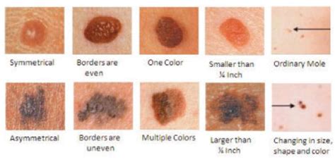 What Are The Most Common Skin Cancers Cancerwalls