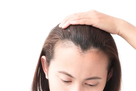 Hair Loss In Women Over 50