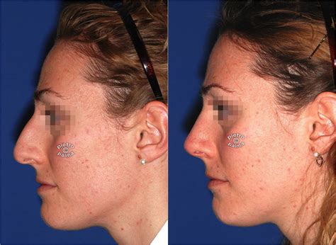 Reduction Rhinoplasty Before And After Photo
