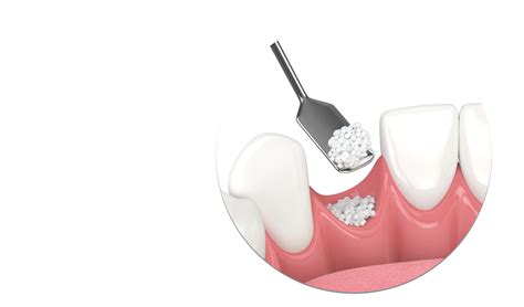 Bone Graft Drbk Cosmetic Dentist And Aesthetics Clinic In Reading