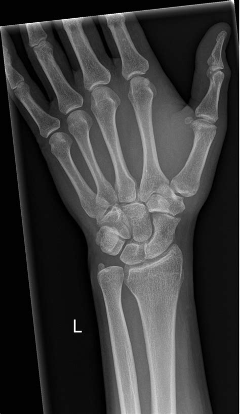 Wrist Anatomy X Ray