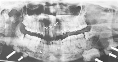 Opg Demonstrates Impacted Teeth 21 And 23 Homogenous Radiopaque Masses