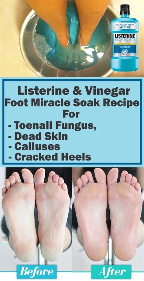 listerine and vinegar foot miracle soak recipe for toenail fungus dead skin calluses and cracked