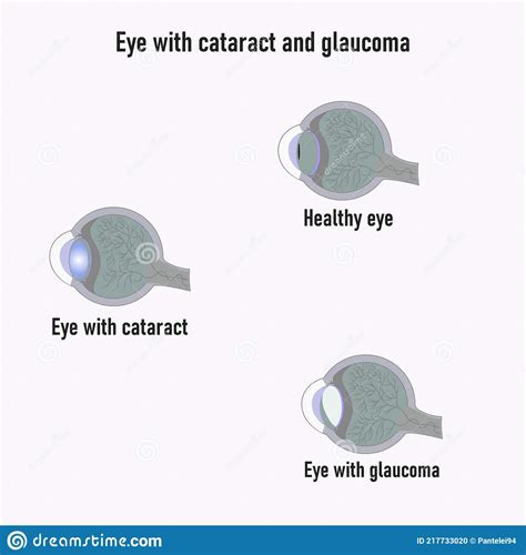Glaucoma Eye Development Of Glaucoma The Structure Of The Eye