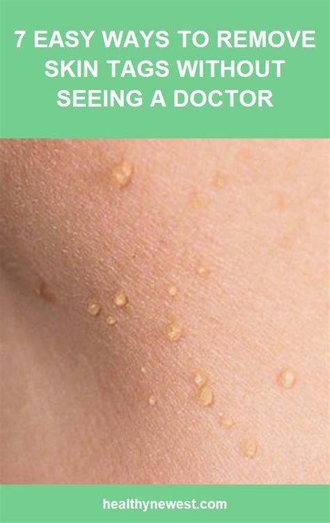 7 easy ways to remove skin tags without seeing a doctor with images skin tag removal skin