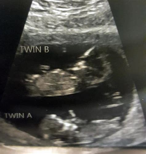 Identical Twins In Ultrasound Gender Prediction Forum