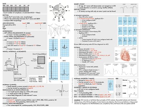 Printable 12 Lead Ekg Interpretation Cheat Sheet