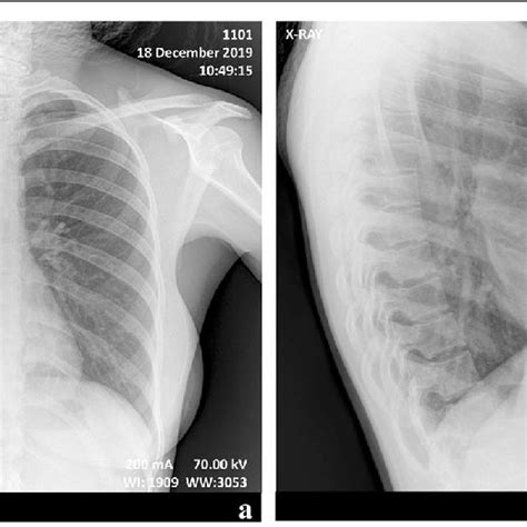 Chest X Rays Of Patient 2 Subnormal Chest X Rays Of A 25 Year Old