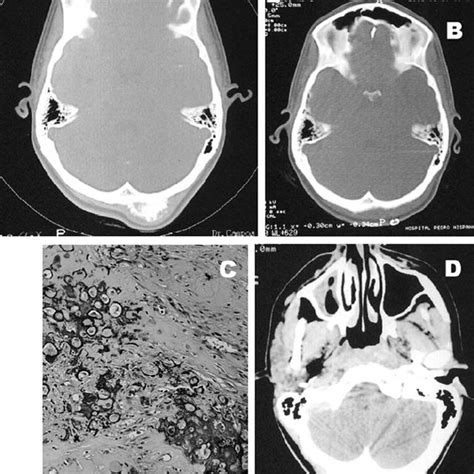 Pdf Skull Osteosarcoma Illustrated Review