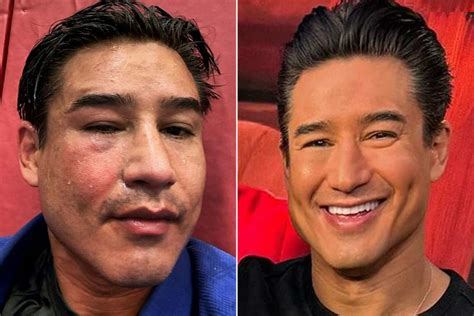 Mario Lopez Shares Before And After Photos Of His Busted Eye From Jiu