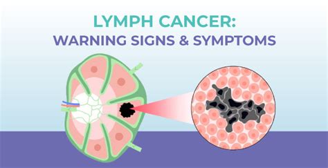 Lymph Cancer Symptoms Types And Warning Signs Mrmed