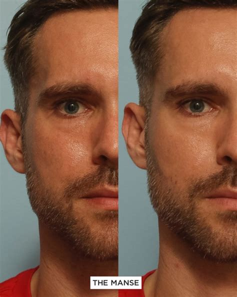 Antiwrinkle Injections For Males Best Clinic Sydney For Dermal Fillers