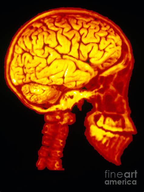 Human Skull X Ray With Digitized Brain Photograph By Scott Camazine