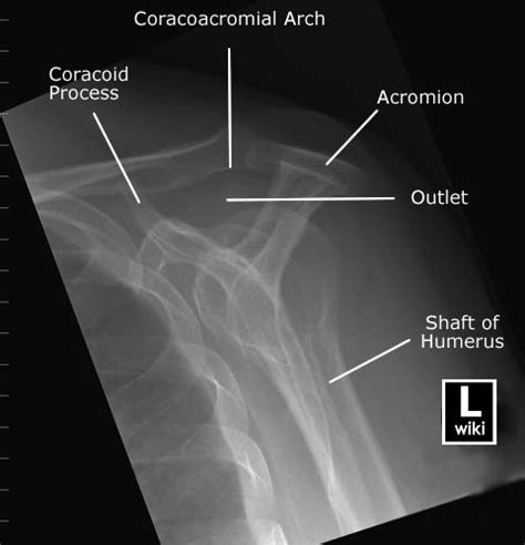 Shoulder Radiographic Anatomy Radiology Student Radiology Imaging