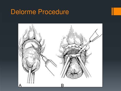 Rectal Prolapse