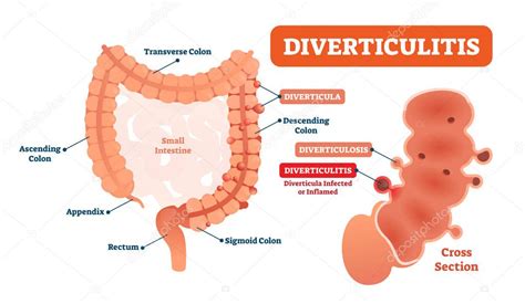 Diverticulitis vector ilustración Diagrama etiquetado con su