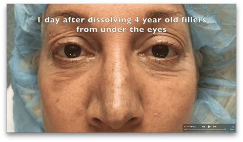 Dissolving Fillers Under The Eyes Dr Adam Scheiner